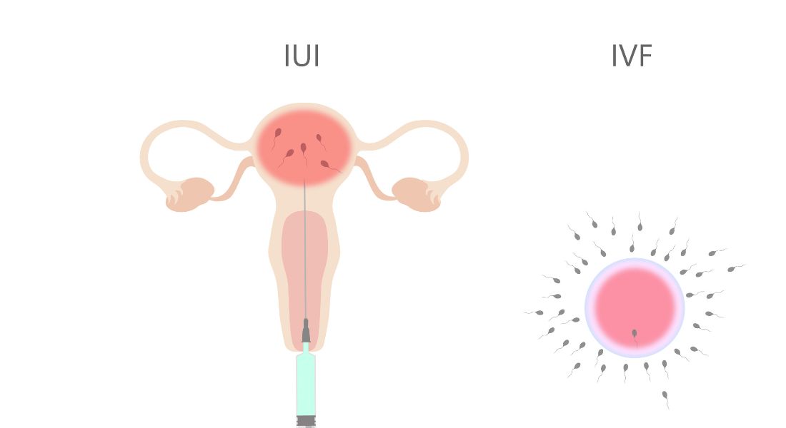 What is the Difference Between an IUI and IVF?