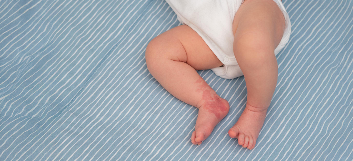 Common skin rashes in children symptoms and causes