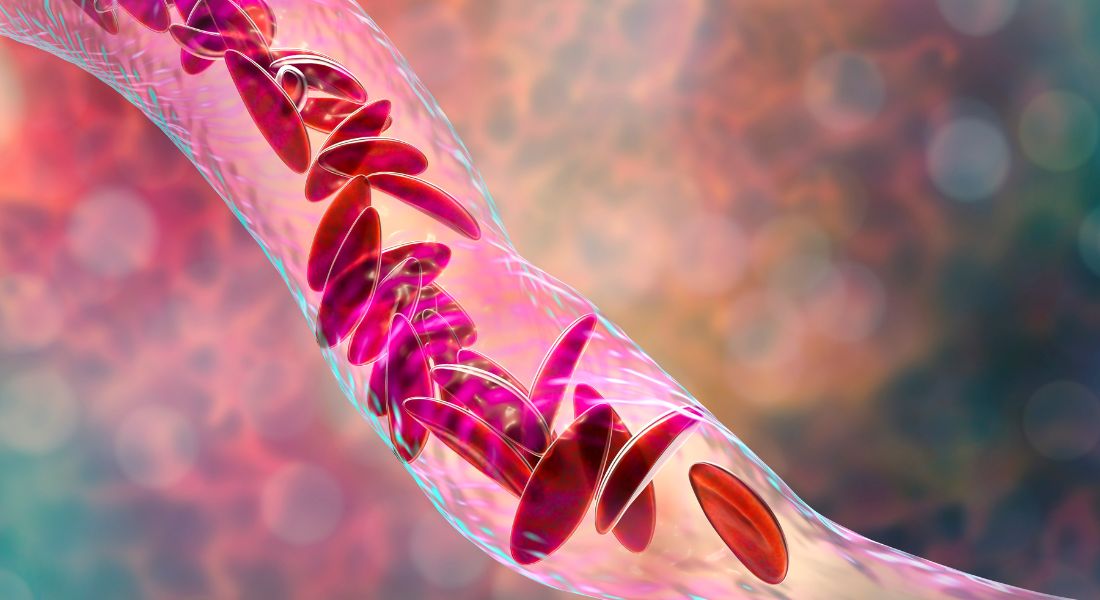 What is sickle cell anemia?
