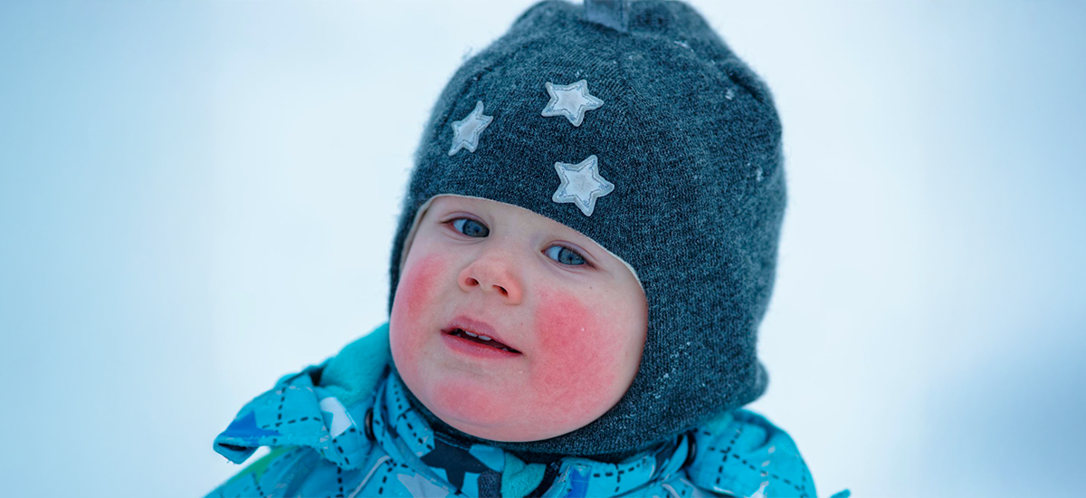 Eczema in Infants During Winter: Triggers, Treatment, and Skincare Routine