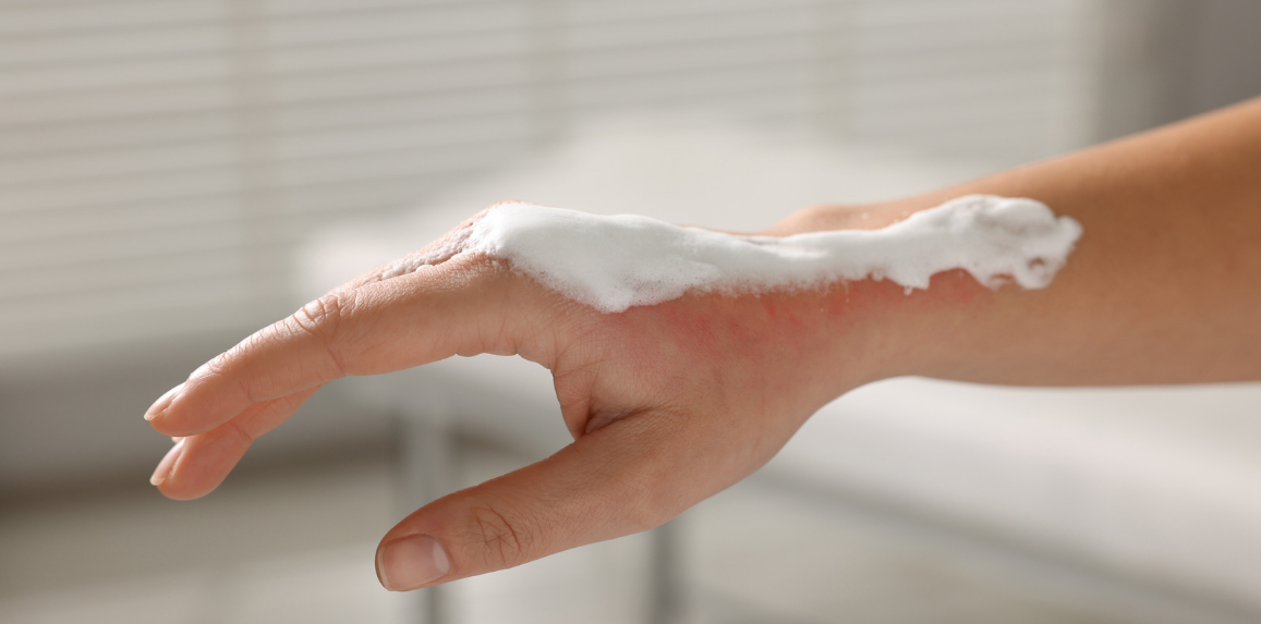 How to Handle Burn Injuries in Kids: A Practical Guide