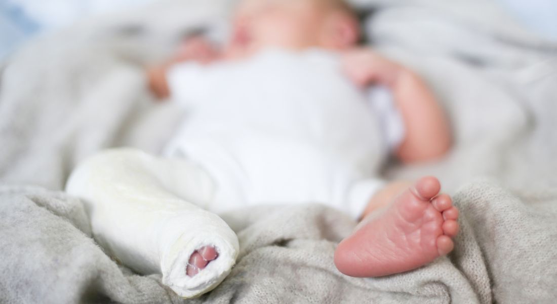 Clubfoot: About the Deformity, Prevention and Treatment