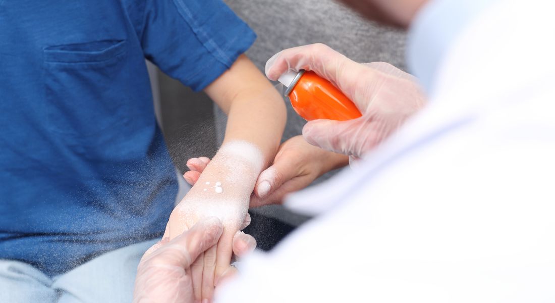 Post burn care in children