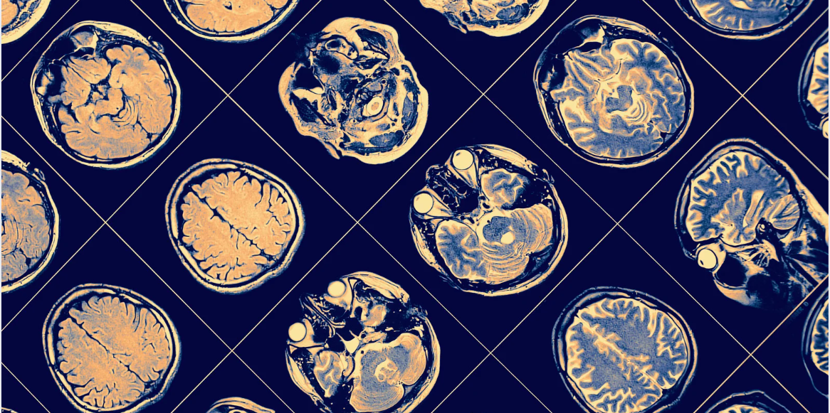 Neurosonogram and Common Doubts