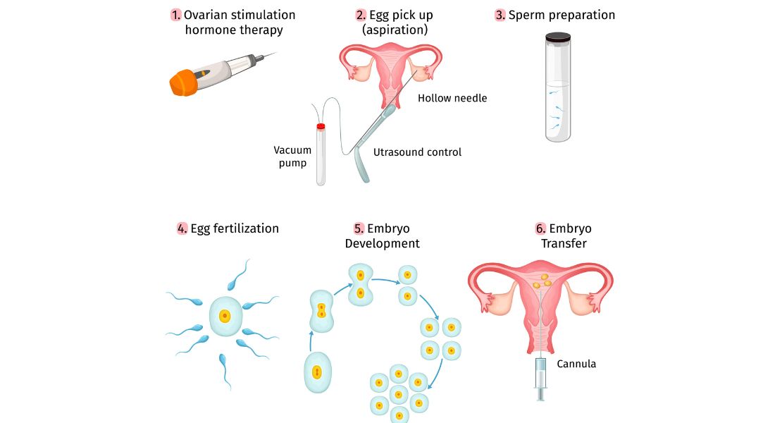 Stages of IVF