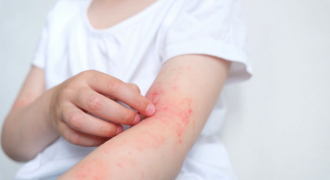 Common Allergies in Children to Watch Out For