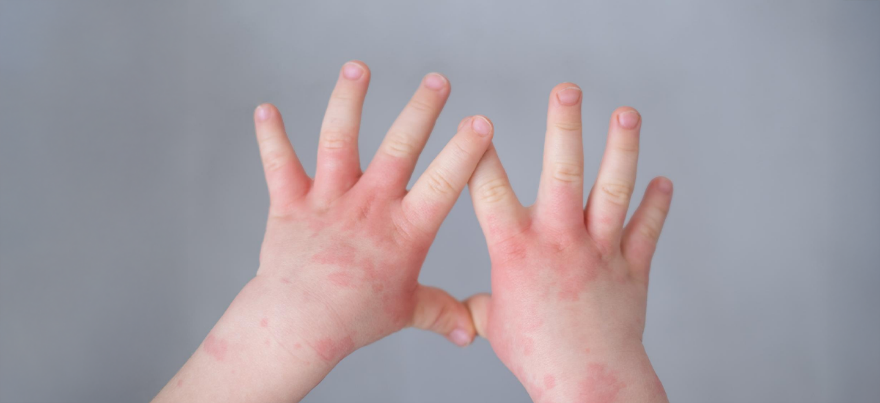 Understanding Blood Disorders in Children: Symptoms & Treatments