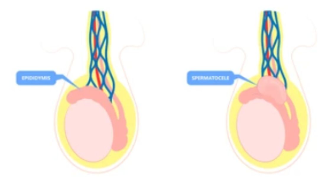 The Problem of Undescended Testes