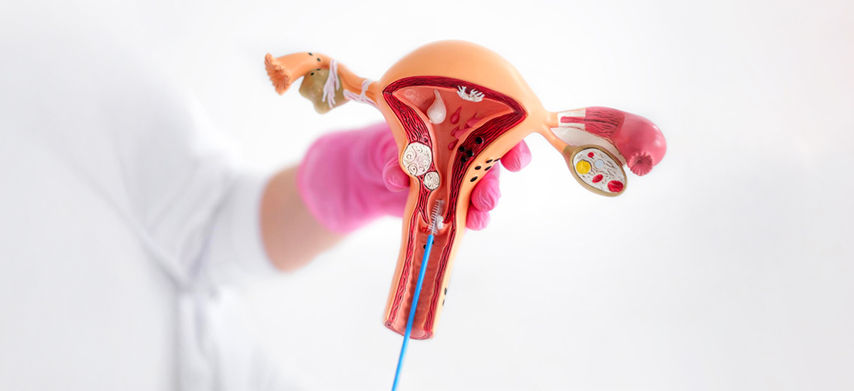 Ovarian Cyst Symptoms: When Is Treatment Needed?