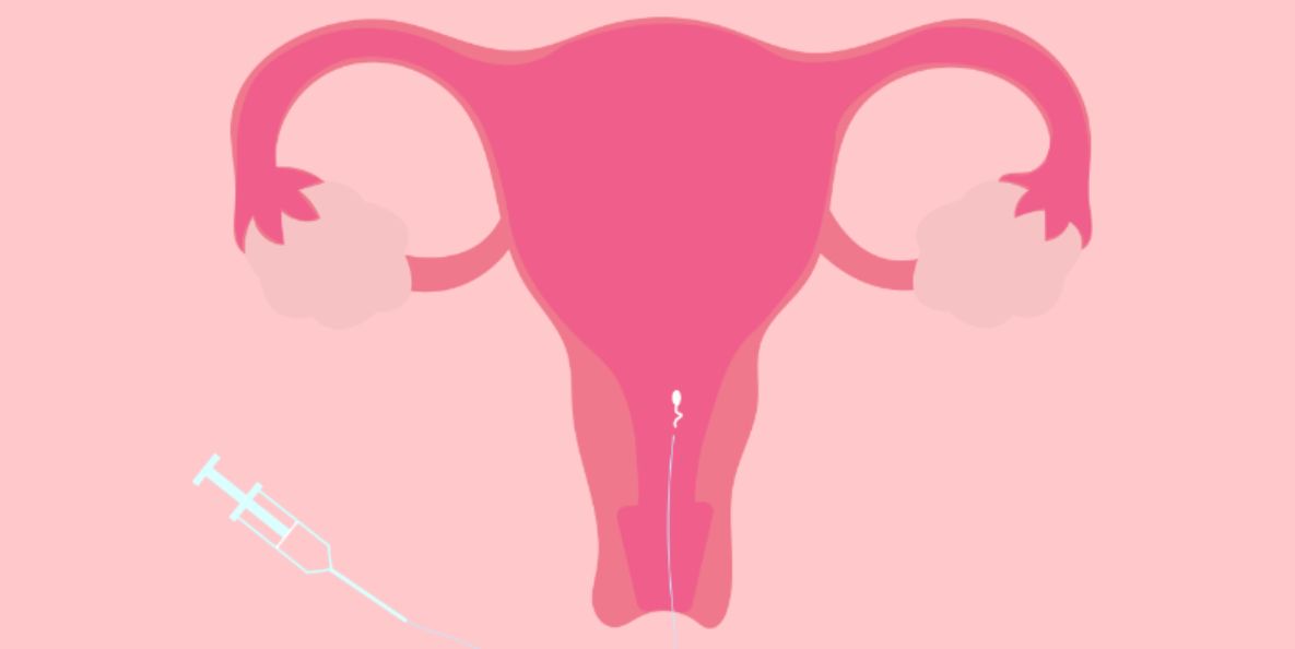 Step by step guide to IUI