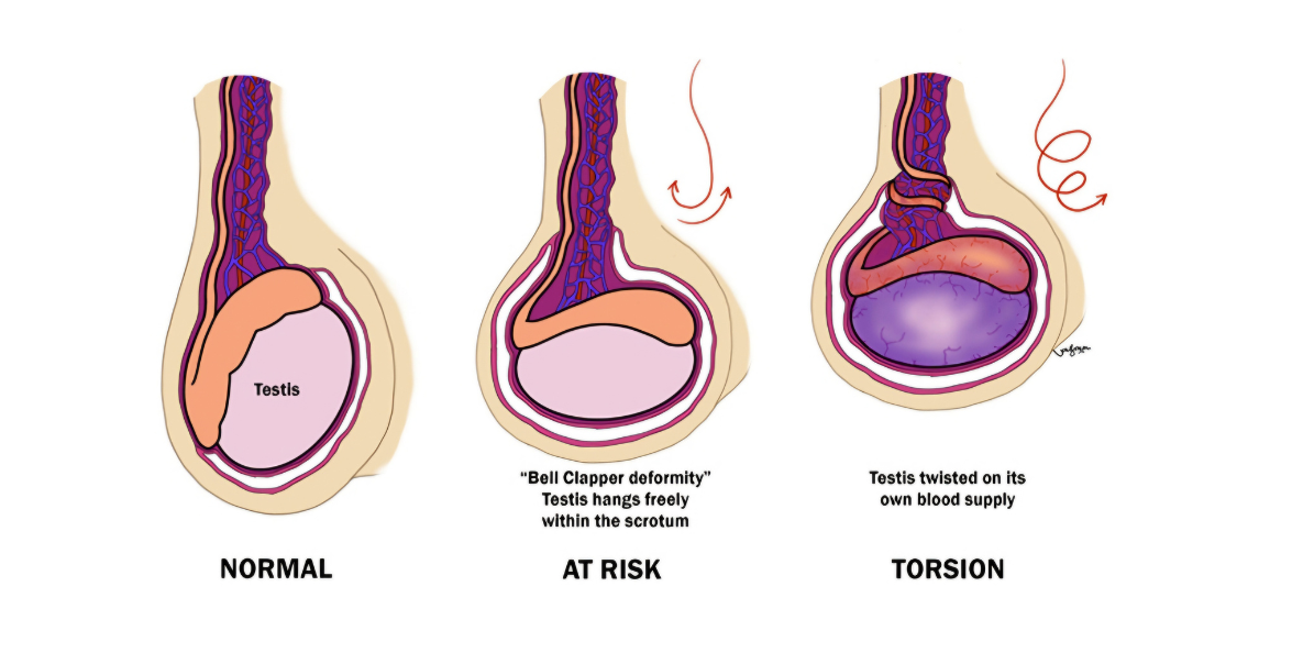 Understanding Testicular Torsion in Young Boys: A Critical Surgical Emergency