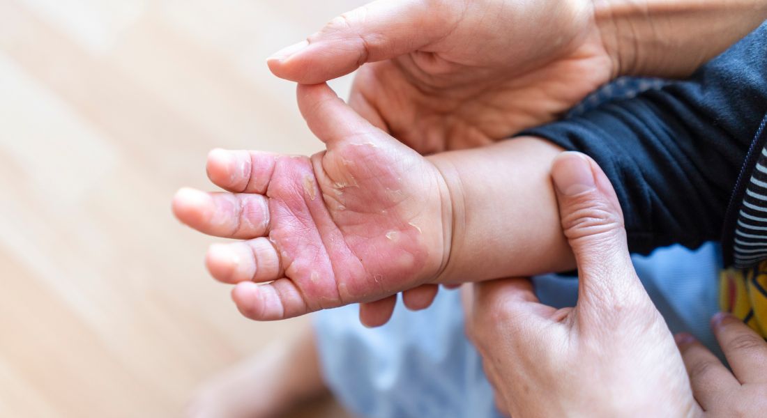 Burns in Children