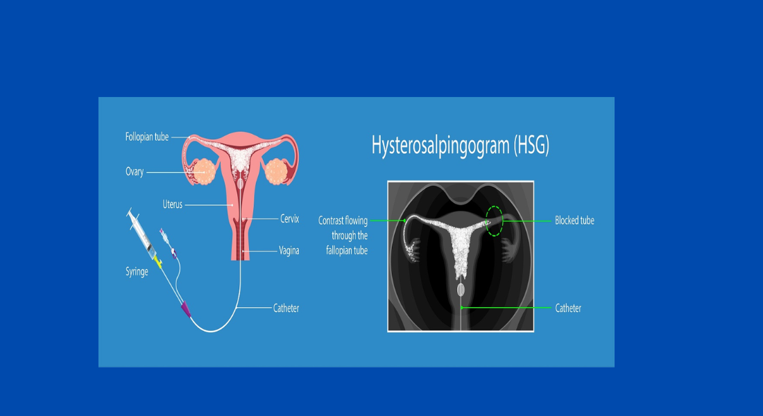 What is Hysterosalpingography (HSG)?