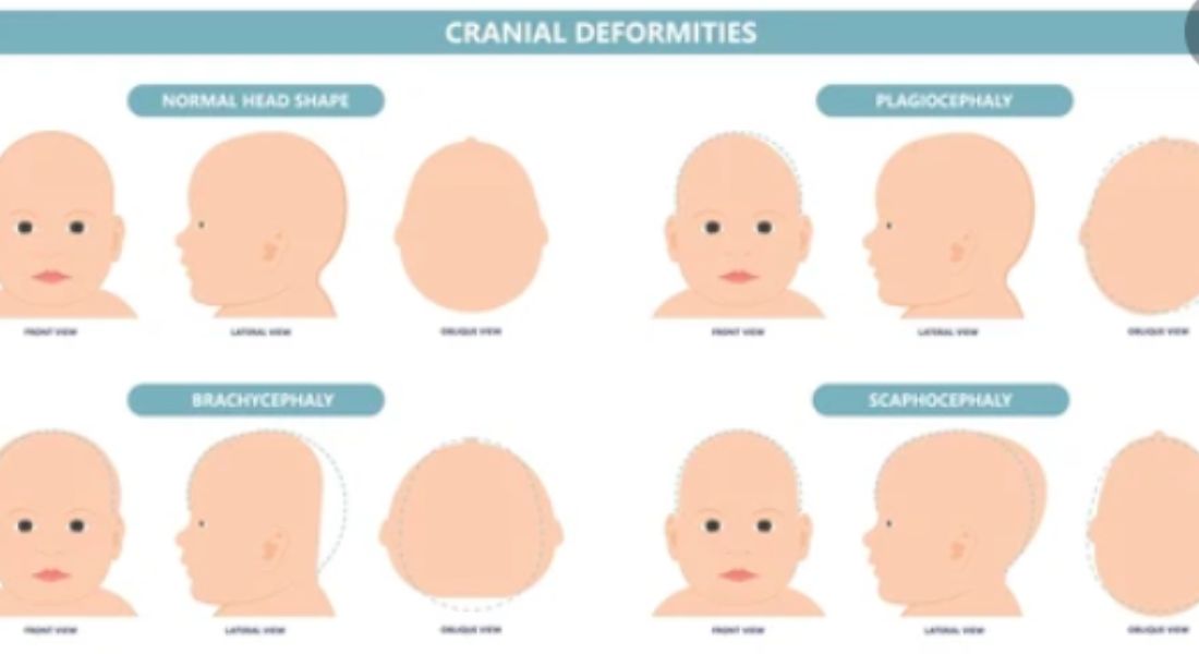 Abnormal Skull Shape in Children – Types and FAQs Answered