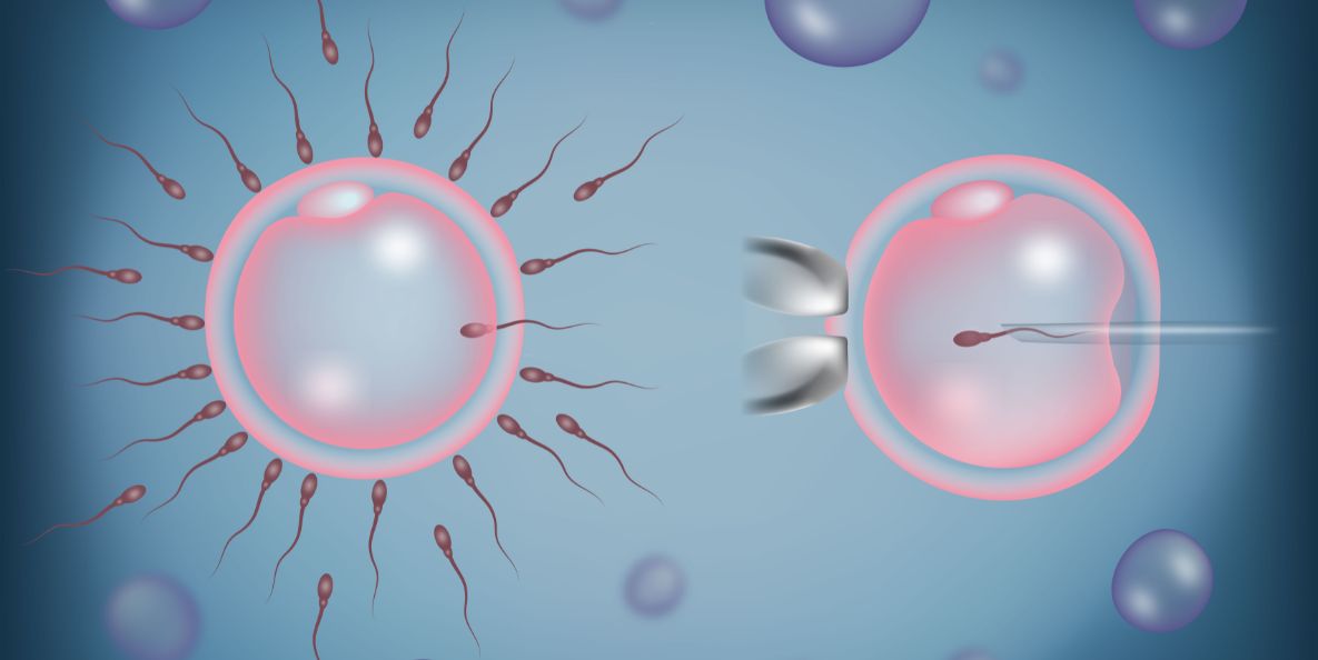 How Does Intracytoplasmic Sperm Injection (ICSI) Treatment Work?