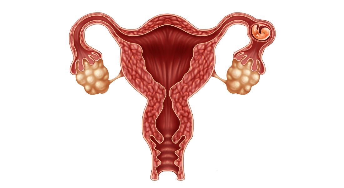 Ectopic Pregnancy- Symptoms, Causes and Treatments