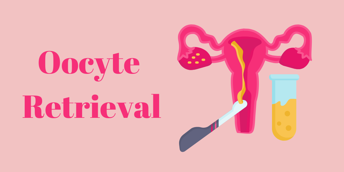 Oocyte Retrieval