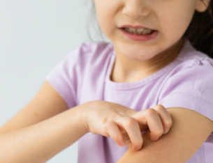 Allergies are on the Raise by Dr. Spurthi Reddy