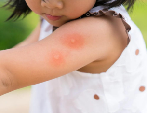 Dengue in Children