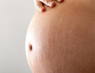 Stretch marks in pregnancy: Embracing the scars