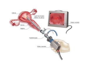 Hysteroscopy- Procedure Of Choice For Intrauterine Problems