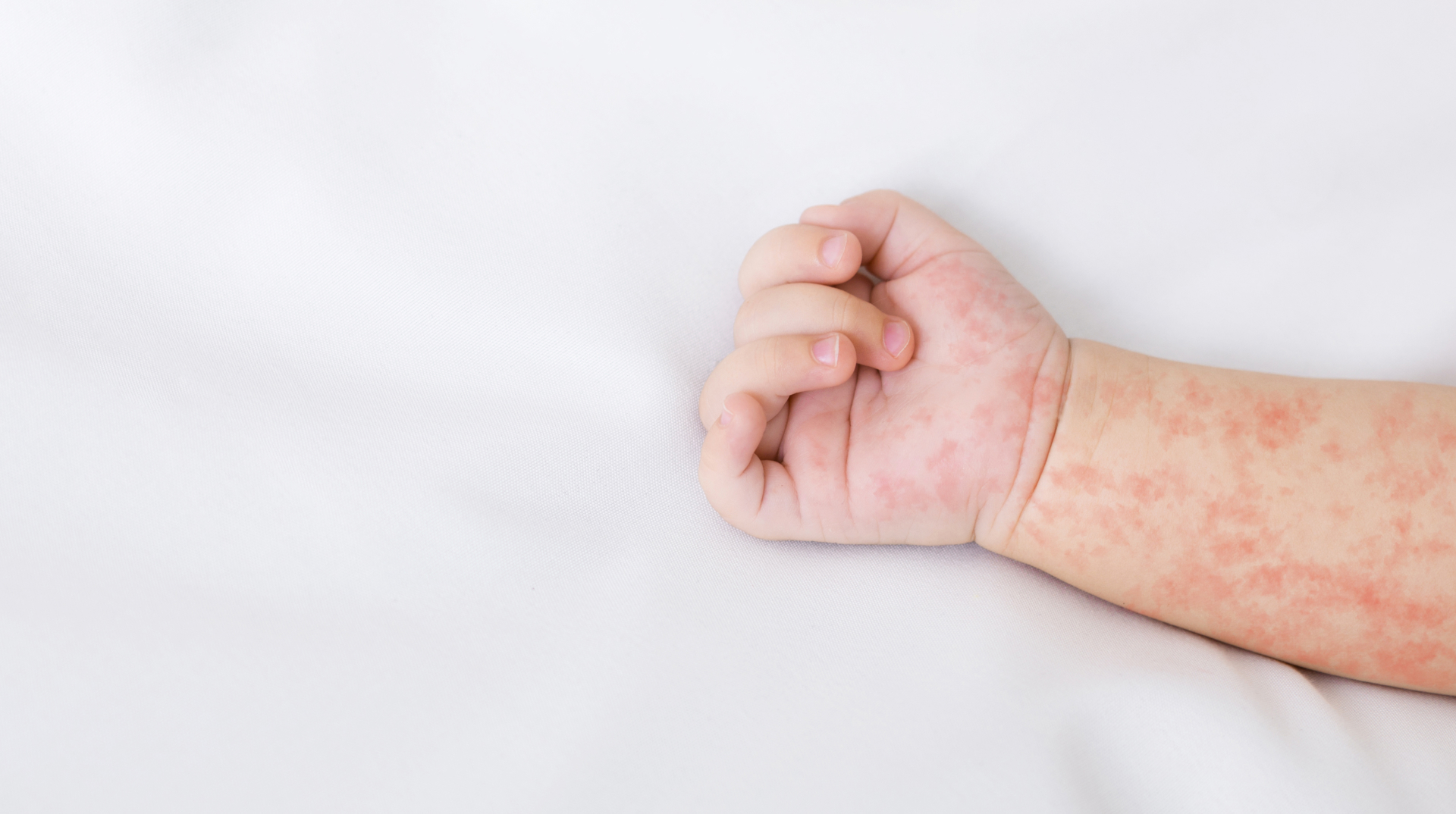 Best pediatric allergy specialist Hyderabad